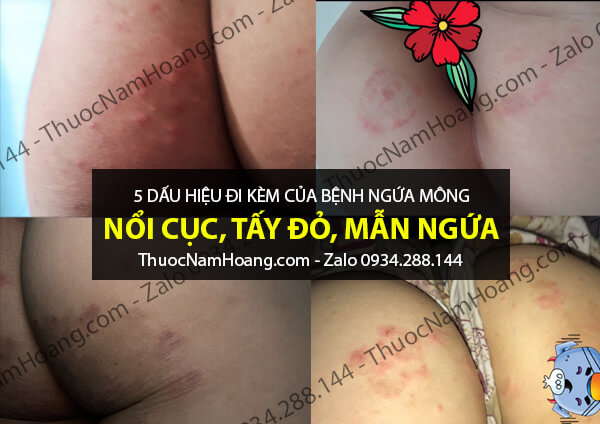 ngứa mông là bệnh gì