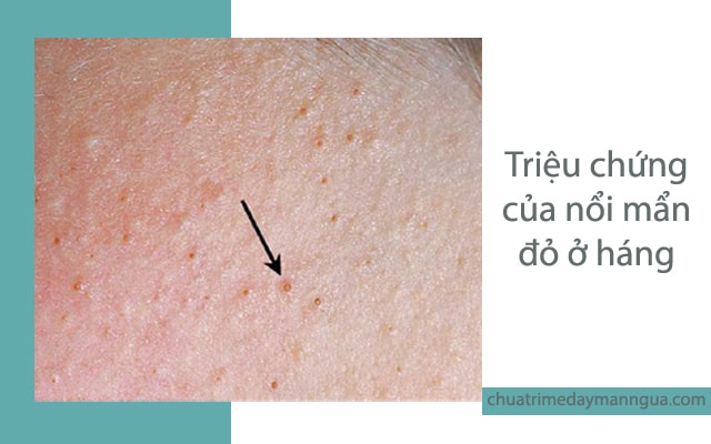 nổi mẩn đỏ không ngứa ở háng do lang beng
