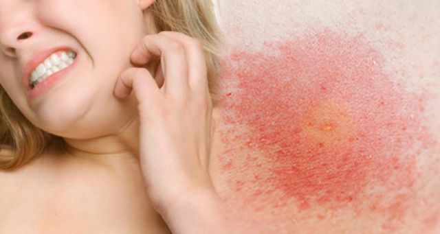 bị ngứa tay chân về đêm