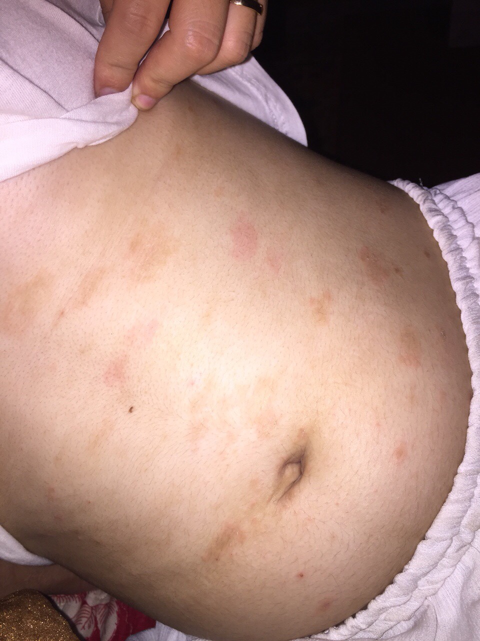 bà bầu bị ngứa tay chân về đêm