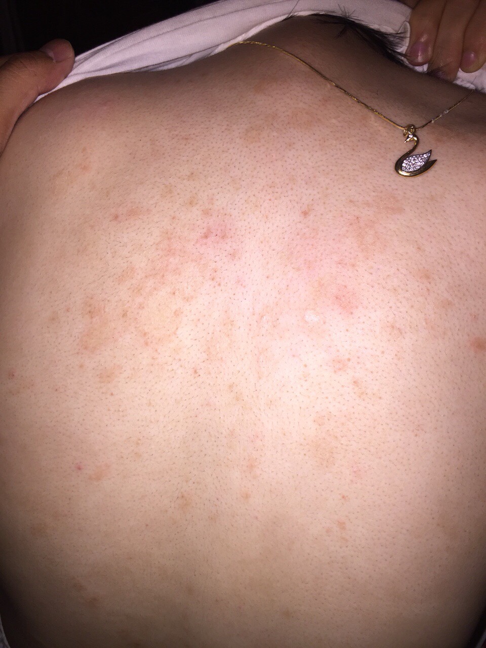 ngứa lưng về đêm