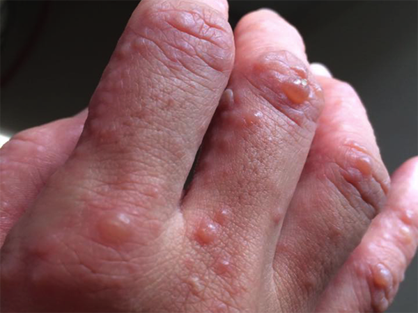 ngứa đầu ngón tay về đêm