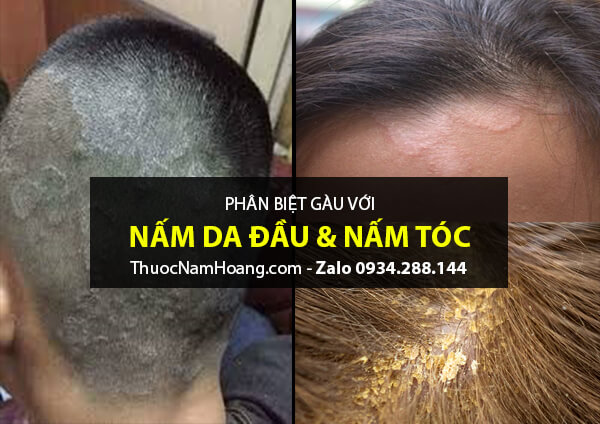 phân biệt gàu, nấm da đầu, vảy nến da đầu