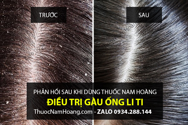 cách trị gàu tận gốc với thuốc nam hoàng