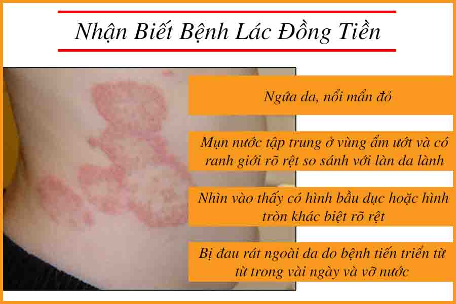 Dấu hiệu nhận biết bệnh lác đồng tiền