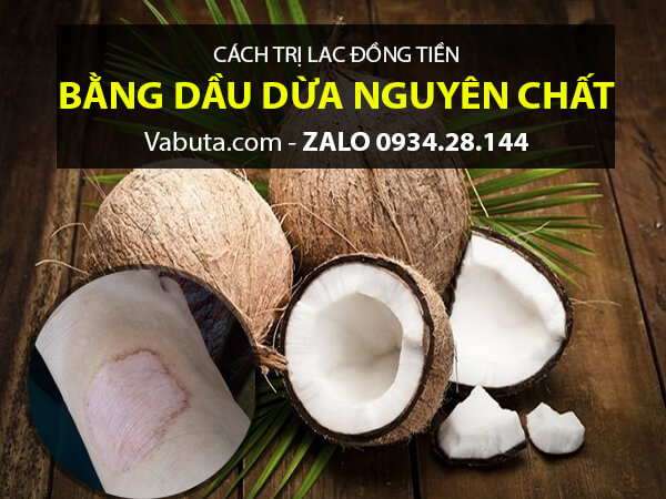 Dầu Dừa trị lác đồng tiền