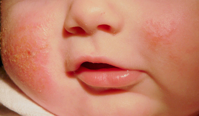 lác đồng tiền ở trẻ em