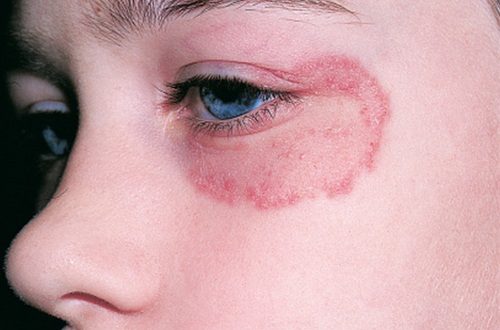 lác đồng tiền ở trẻ có nguy hiểm gì không