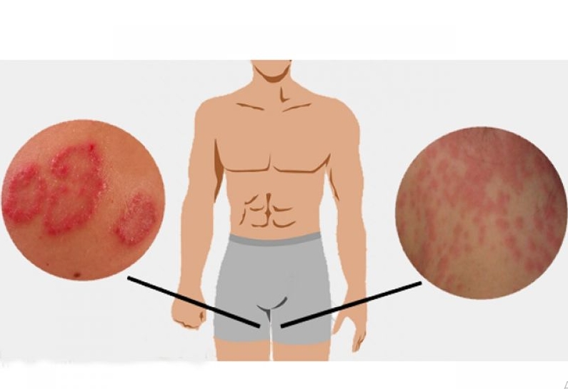 Có nên sử dụng cách trị lác đồng tiền ở háng bằng dân gian không