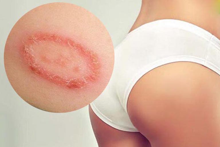 bệnh lác đồng tiền ở mông