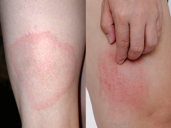 Dấu hiệu bị lác đồng tiền ở chân