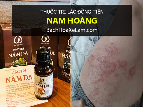 Điều trị lác đồng tiền ở chân bằng thuốc nam hoàng