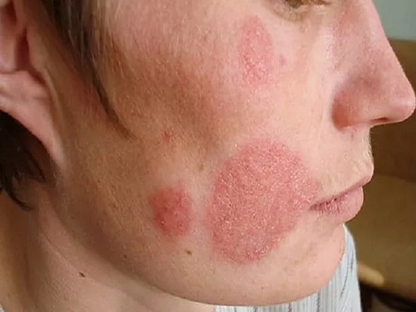 Bệnh lác đồng tiền ở mặt có nguy hiểm và lây lan không