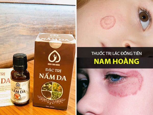 Điều trị lác đồng tiền ở mặt dứt điểm bằng thuốc nam hoàng