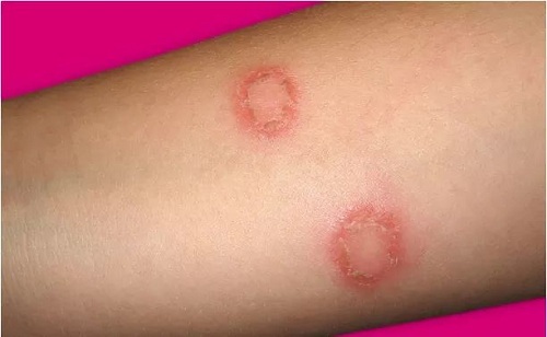 lác đồng tiền lây qua đường nào