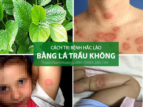Lá trầu không trị hắc lào ở tay chân