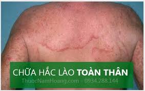 bị hắc lào lâu năm chữa được không?