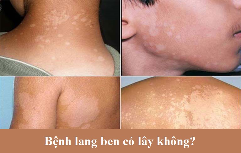 Bệnh lang ben có lây không