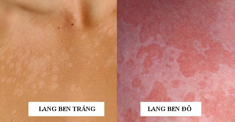 lang beng đỏ