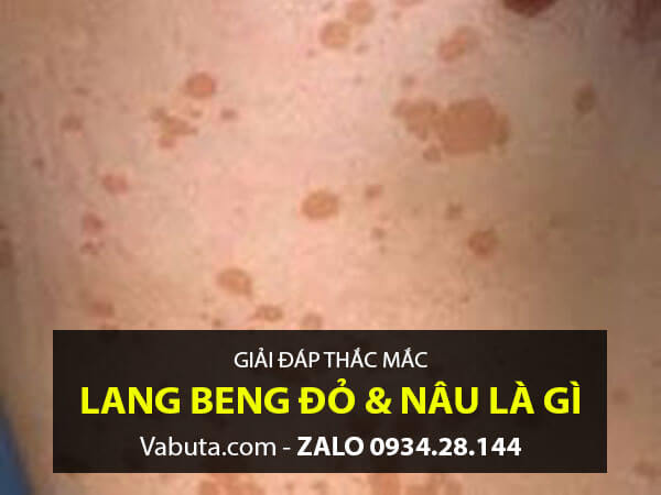 bệnh lang beng đỏ nguy hiểm không