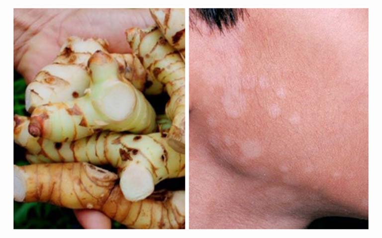 Củ Riềng trị lang beng đỏ hiệu quả