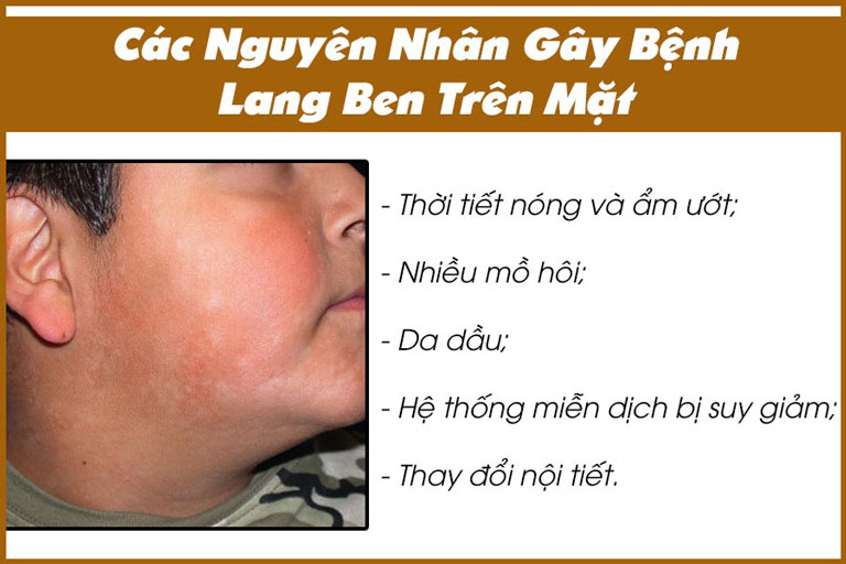 nguyên nhân bị lang beng ở mặt
