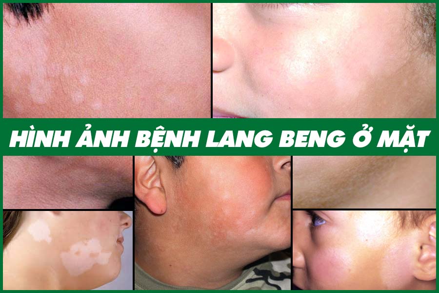 dấu hiêu của lang beng ở mặt