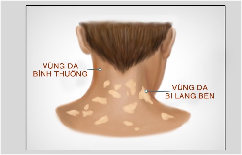 lang beng có nguy hiểm không