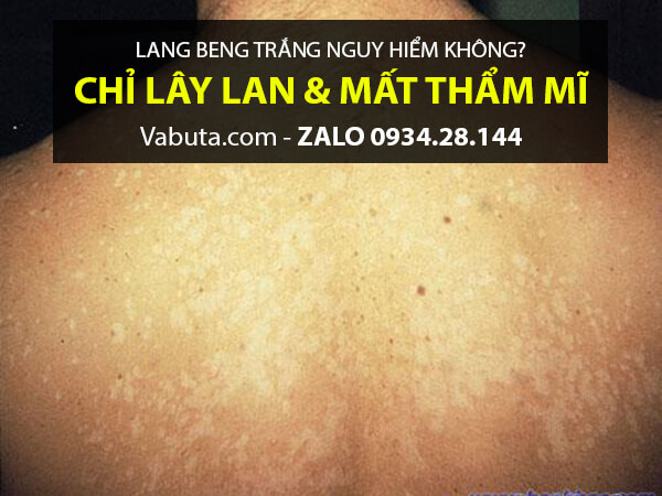 bệnh lang beng có lây không