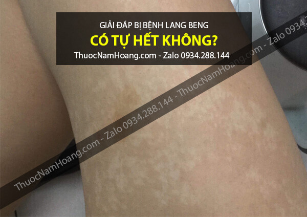 Bệnh lang ben có tự khỏi không