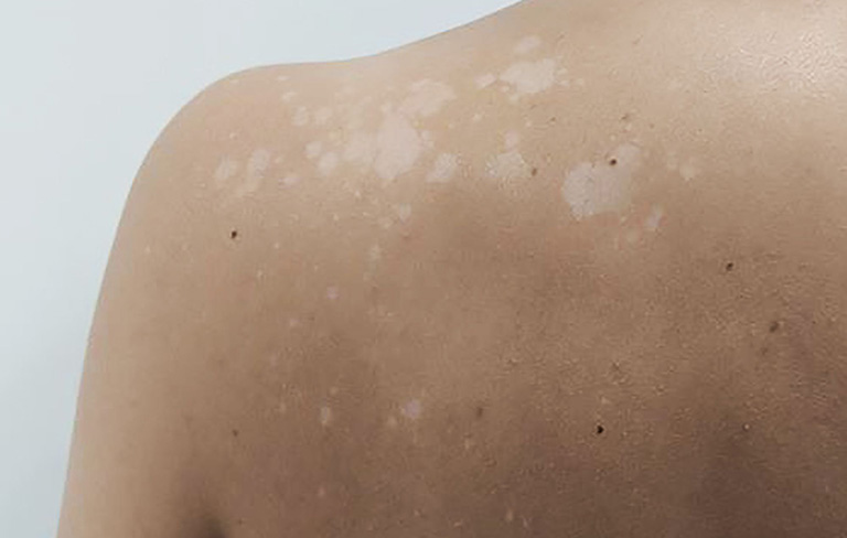 Bị lang beng trắng có nguy hiểm