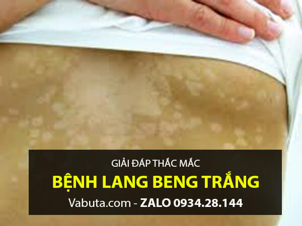 Trị bệnh lang beng bằng dân gian được không