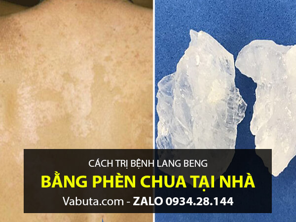 Dùng phèn chua trị lang beng