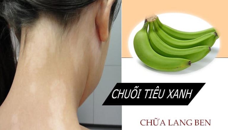 trị lang beng bằng chuối xanh