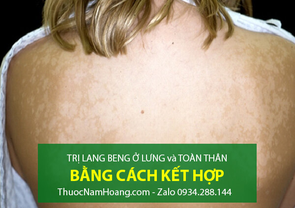 nguyên nhân bệnh lang ben toàn thân