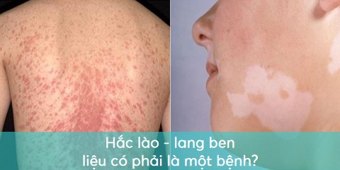 phân biệt lang ben và hắc lào