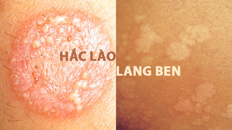 phân biết bệnh hắc lào và lang ben