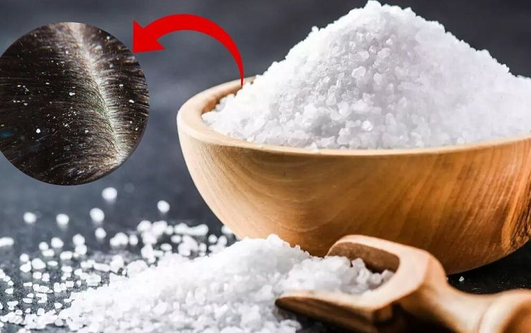Muối trắng giúp giảm gàu và rụng tóc