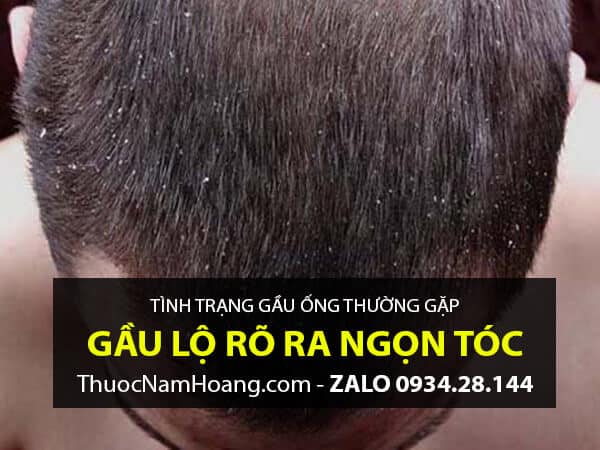 gàu ống