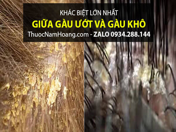 gàu ướt là gì