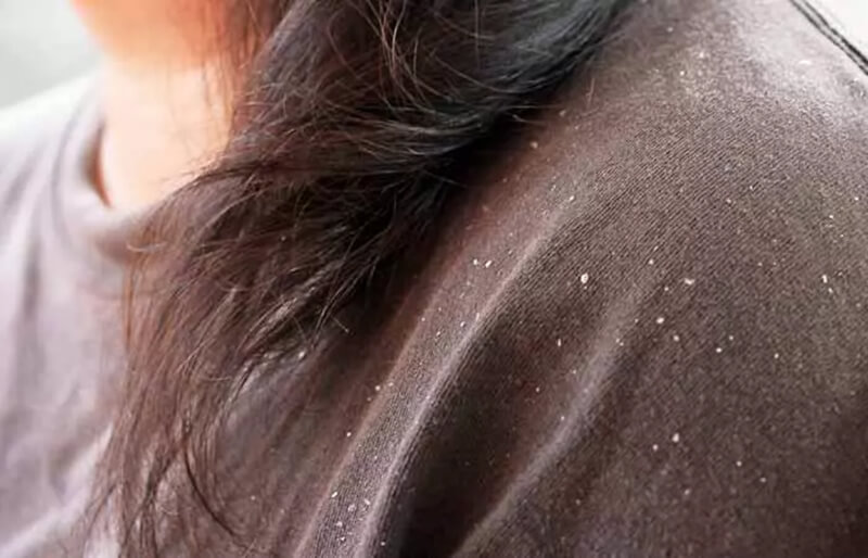 dấu hiệu của gàu ướt