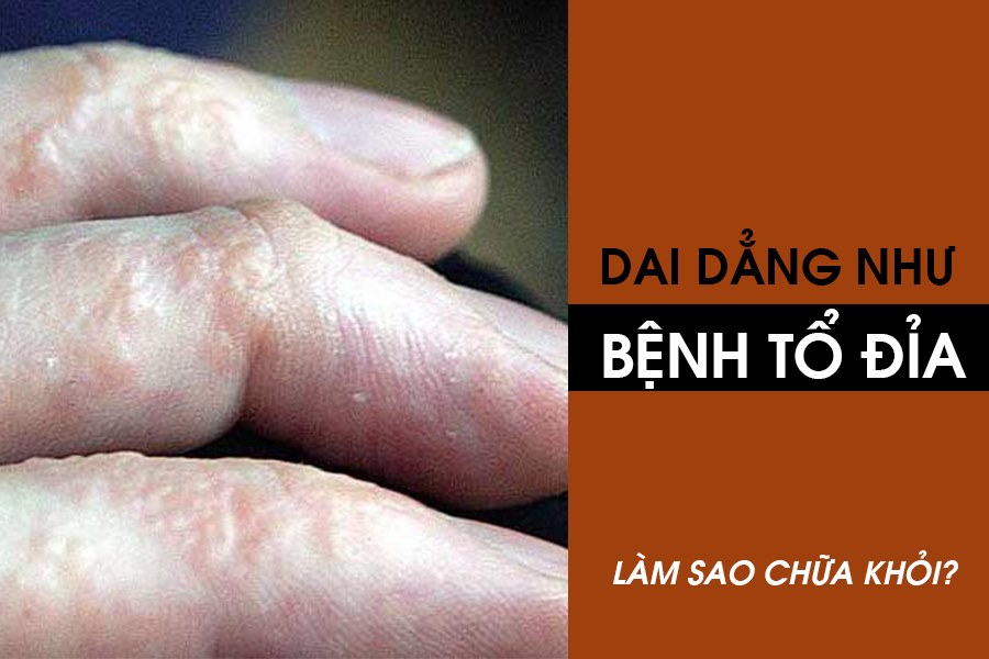 cách trị bệnh tổ đỉa