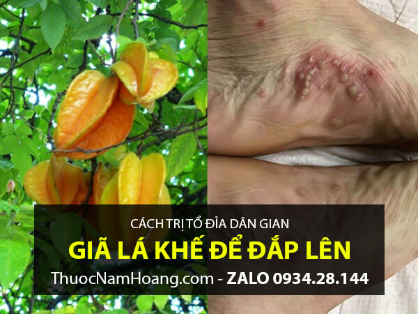 Cách trị tổ đỉa tại nhà bằng lá khế