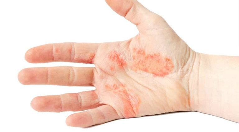 bệnh tổ đỉa có di truyền không
