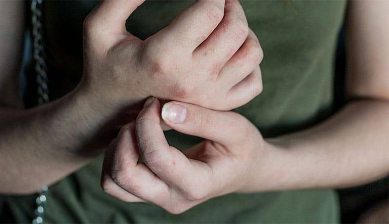 bệnh tổ đỉa có di truyển không nhỉ