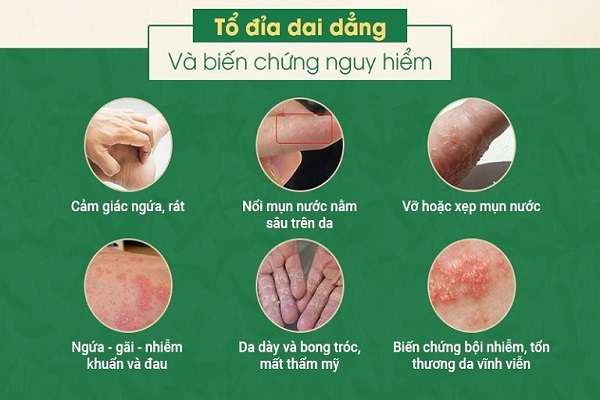 bệnh tổ đỉa có nguy hiểm không