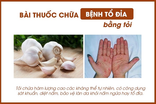 chữa tổ đỉa bằng tỏi