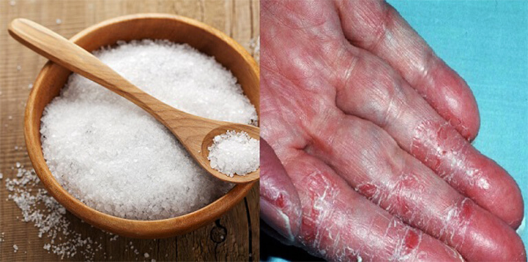 cách chữa tổ đỉa bằng muối