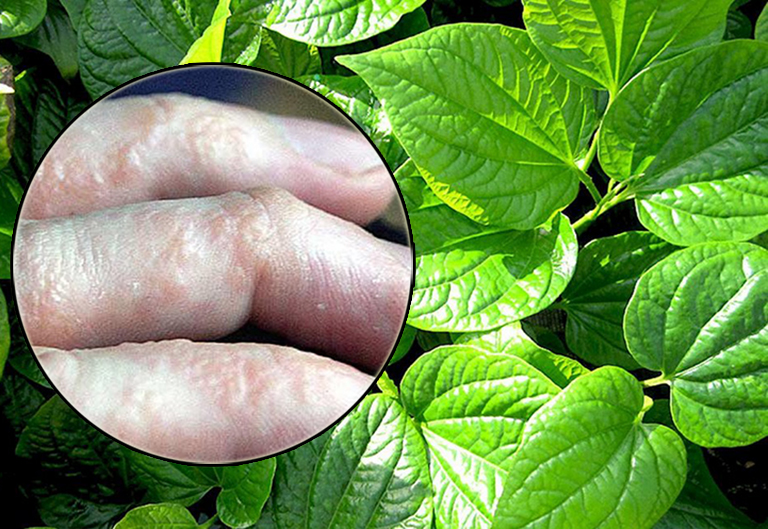 Cách trị tổ đỉa bằng là bàng