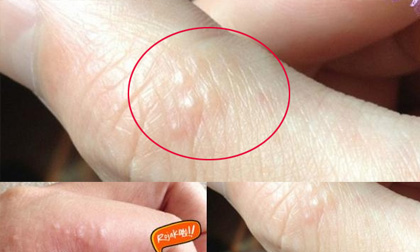 Nguyên nhân Mụn nước mọc thành chùm ở lòng bàn tay, chân